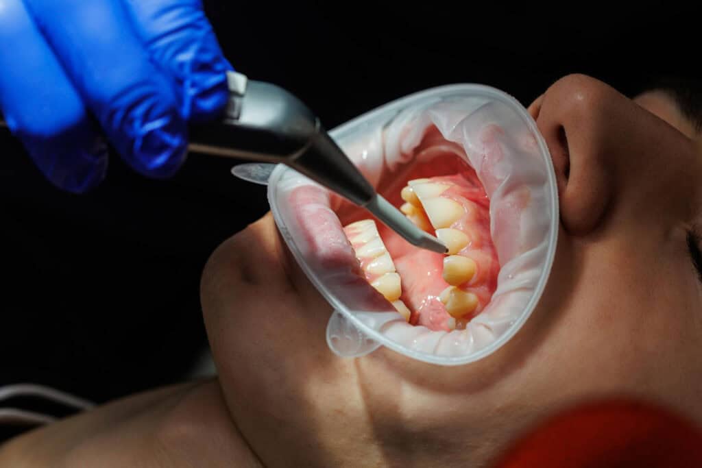 Ridge preservation dental procedure showing a dentist examining a patient's teeth and gums during an extraction visit here.