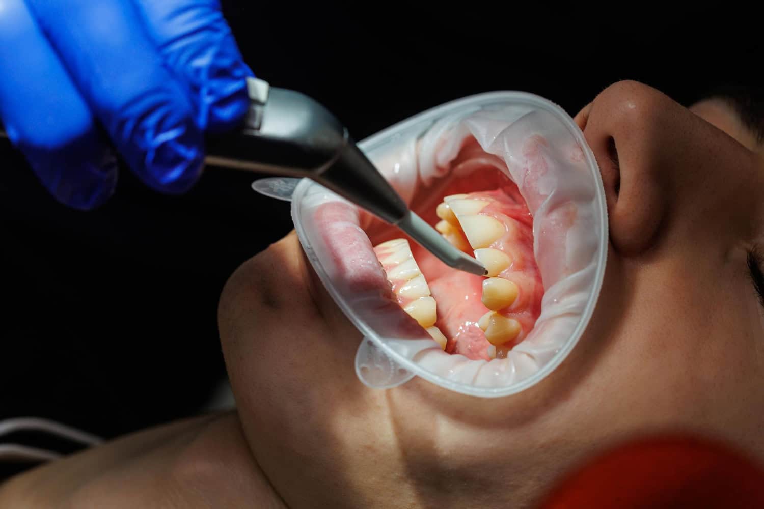 Ridge preservation dental procedure showing a dentist examining a patient's teeth and gums during an extraction visit here.