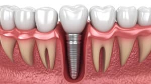 Bone grafting for dental implants showing restored jawbone and implant placement in the gum tissue and bone structures.