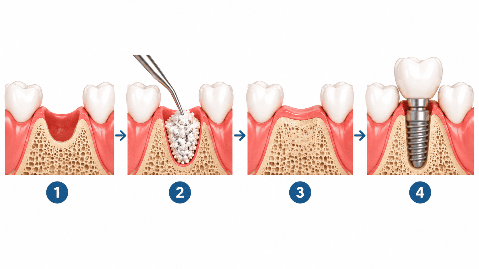 Bone graft before dental implants showing graft placement, healing, and dental implant treatment stages.